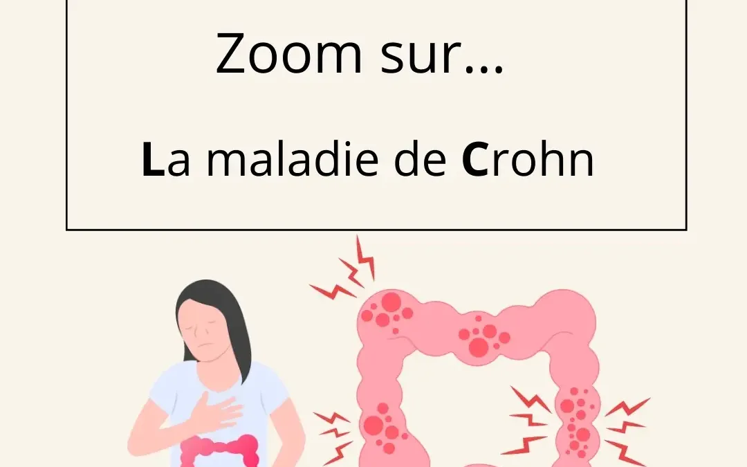 Zoom sur la maladie de Crohn
